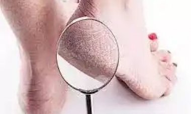 શિયાળામાં હવે નહિ ફાટે એડી, હોઠ અપનાવો આ ઉપાય.